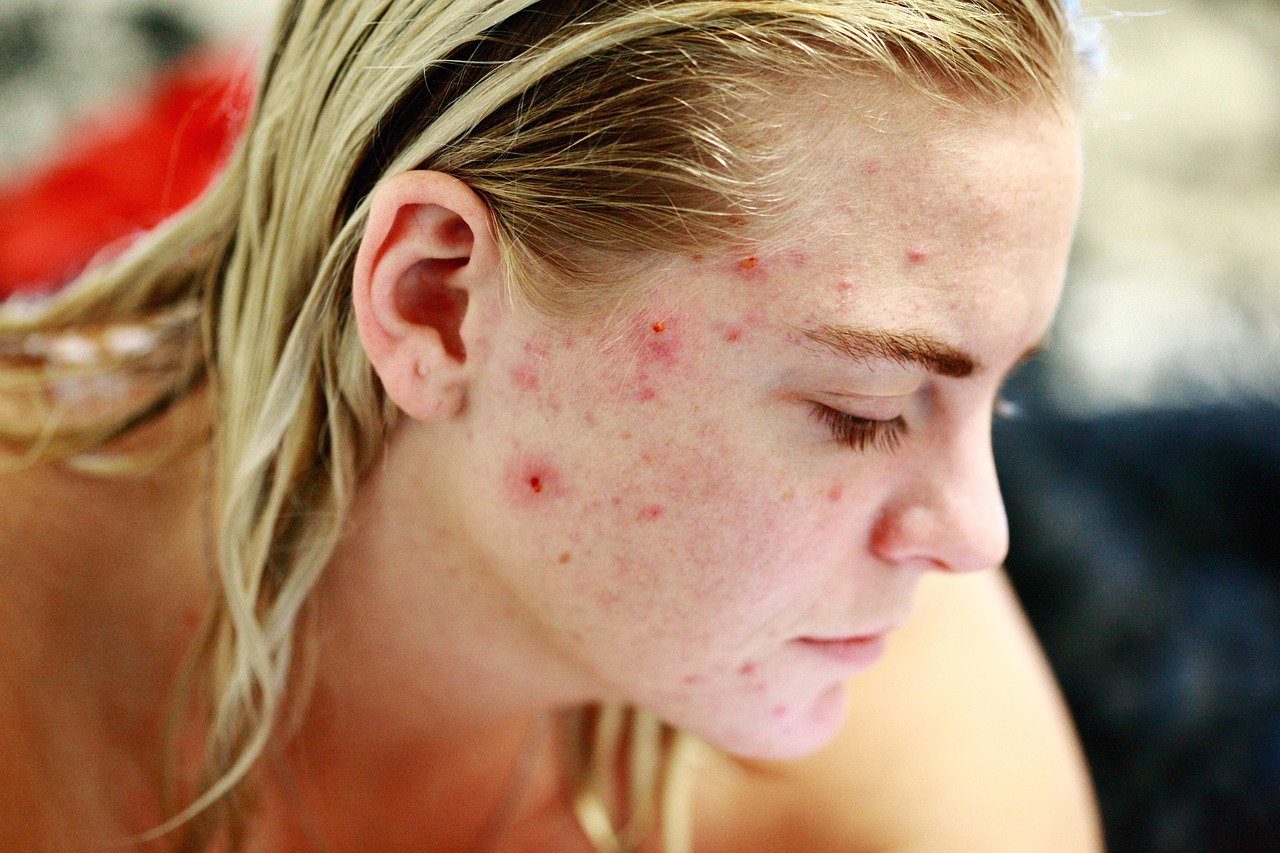 Association Between Food Insecurity and Self-Reported Eczema/Skin Allergy in Adults: A Cross-Sectional Study Using 2012